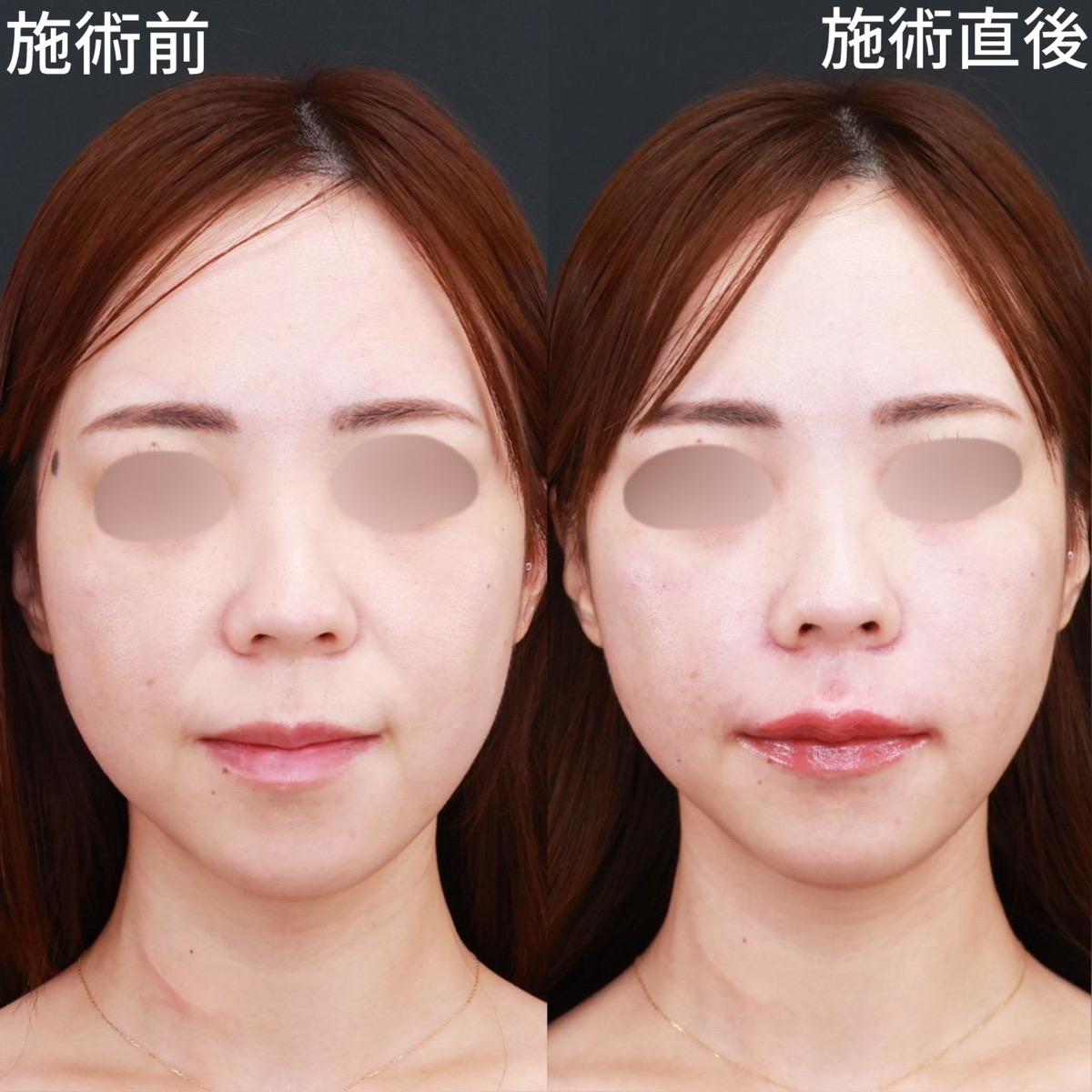 【唇ヒアルロン酸】注射だけで人中を短く見せる！