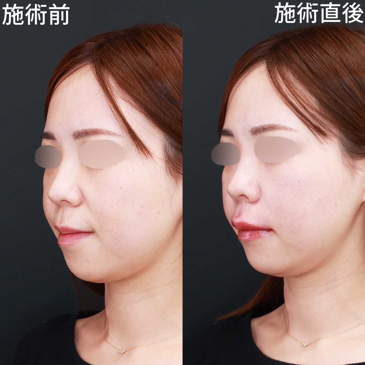 ほうれい線のヒアルロン酸注射/ヒアルロン酸注射：その他の症例写真 施術前後 