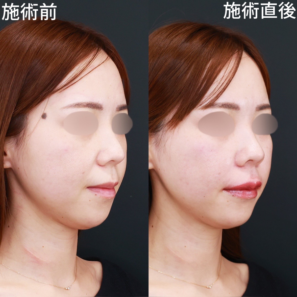 ほうれい線のヒアルロン酸注射/ヒアルロン酸注射：その他の症例写真 施術前後 