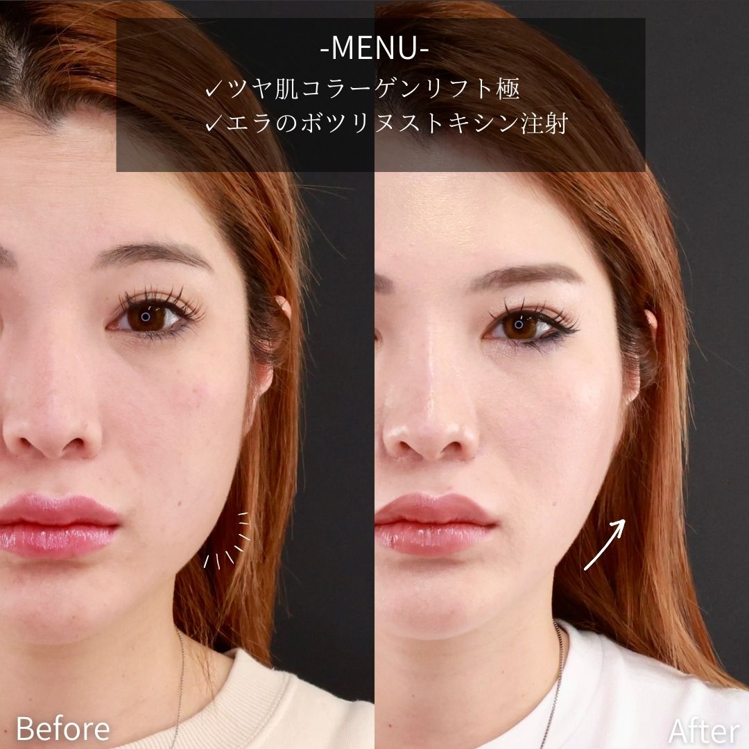 TAC式 ツヤ肌コラーゲンリフト®/エラボトックス注射の症例写真 施術前後 