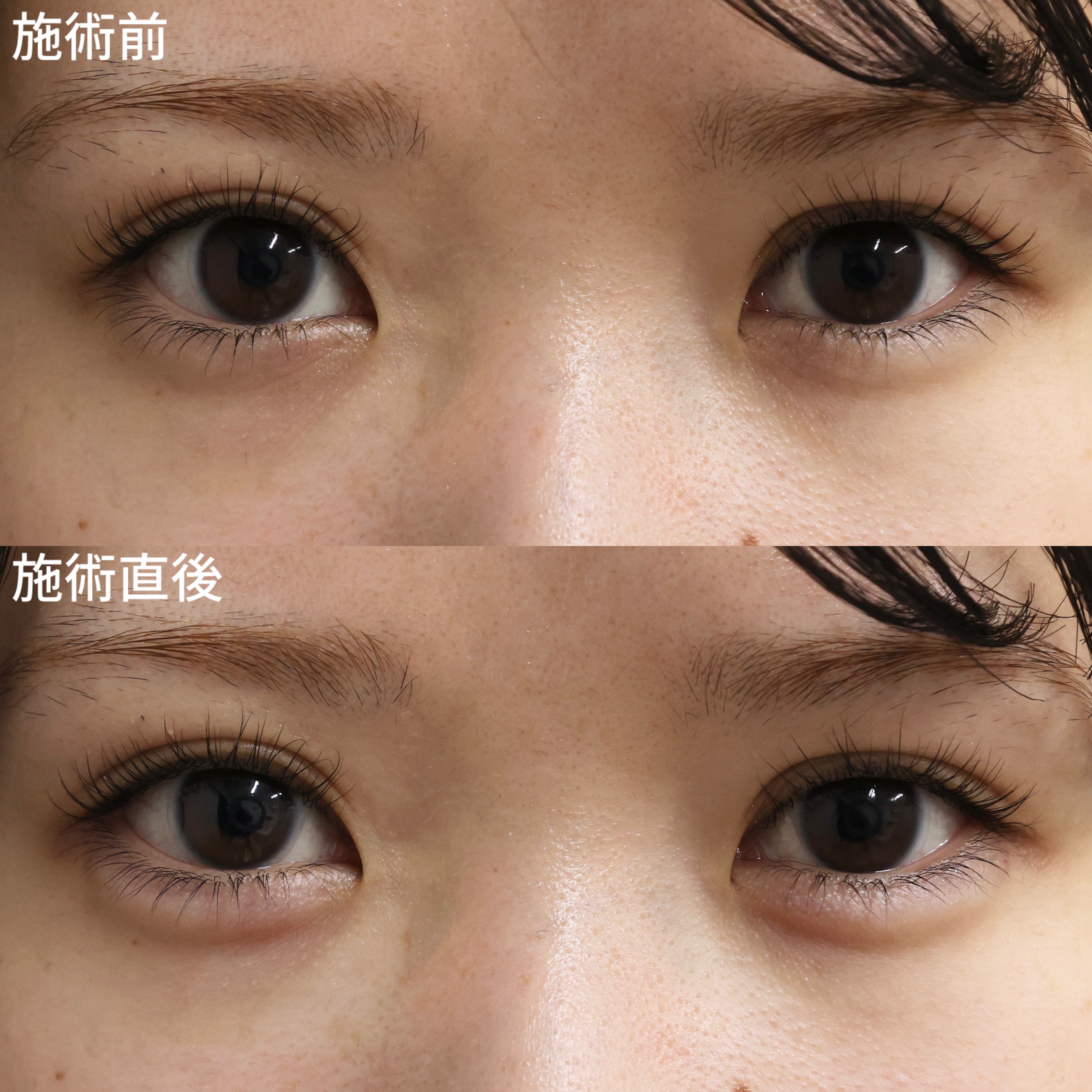 【ヒアルロン酸注射】ぷっくりとした涙袋で可愛さ倍増！