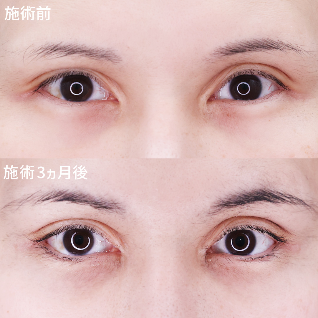 【グラマラスライン】タレ目×デカ目で華やかなお目元に