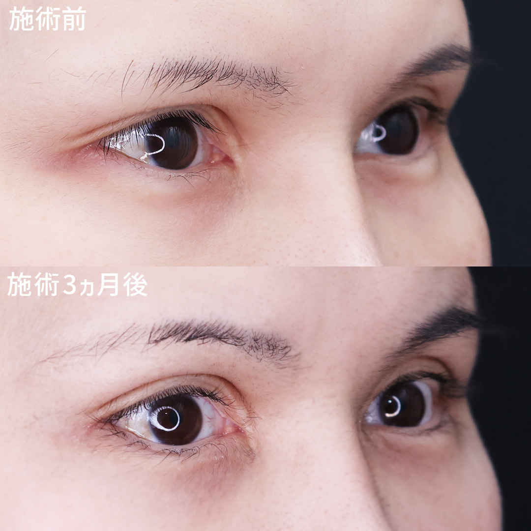 グラマラスライン（タレ目形成）/目尻切開術の症例写真 施術前後 