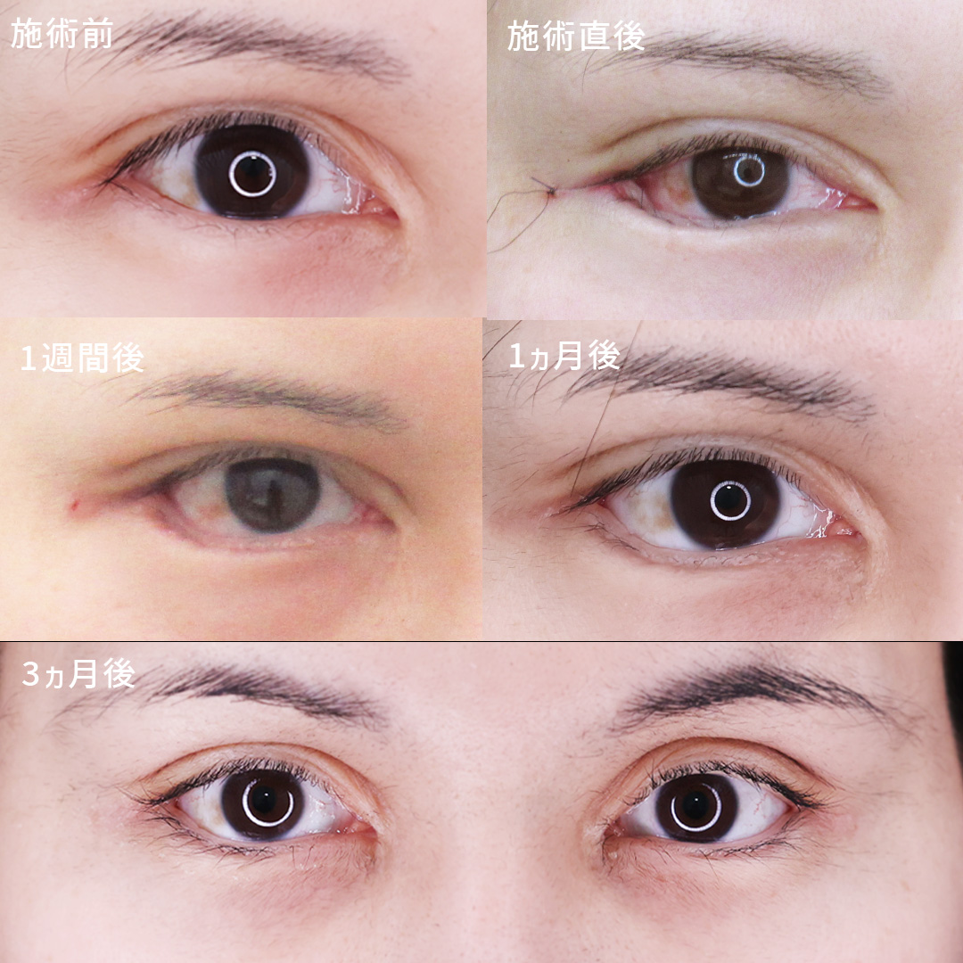 グラマラスライン（タレ目形成）/目尻切開術の症例写真 施術前後 