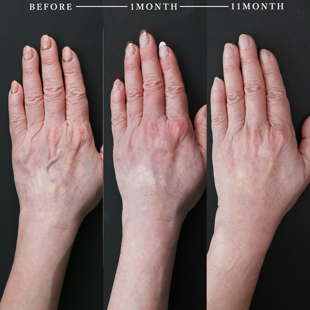 ハンドベイン（手のアンチエイジング・血管治療）の症例写真 施術前後 