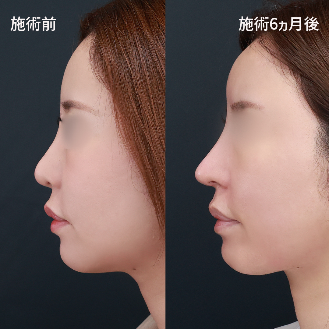 【鼻整形】 美しく、魅せる、理想の鼻