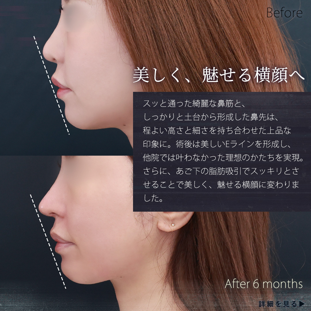 鼻中隔延長術/鼻先軟骨移植/鼻孔縁挙上術の症例写真 施術前後 