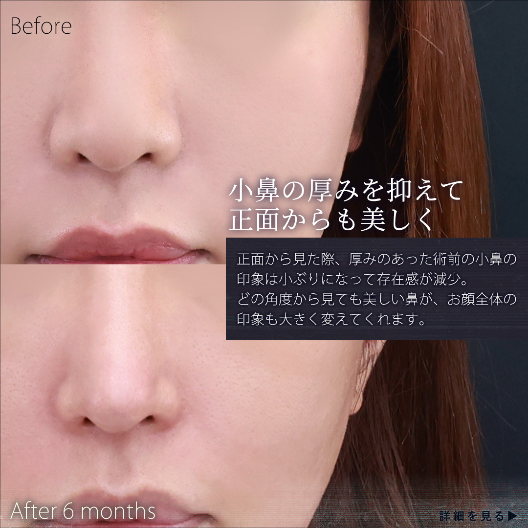 鼻中隔延長術/鼻先軟骨移植/鼻孔縁挙上術の症例写真 施術前後 