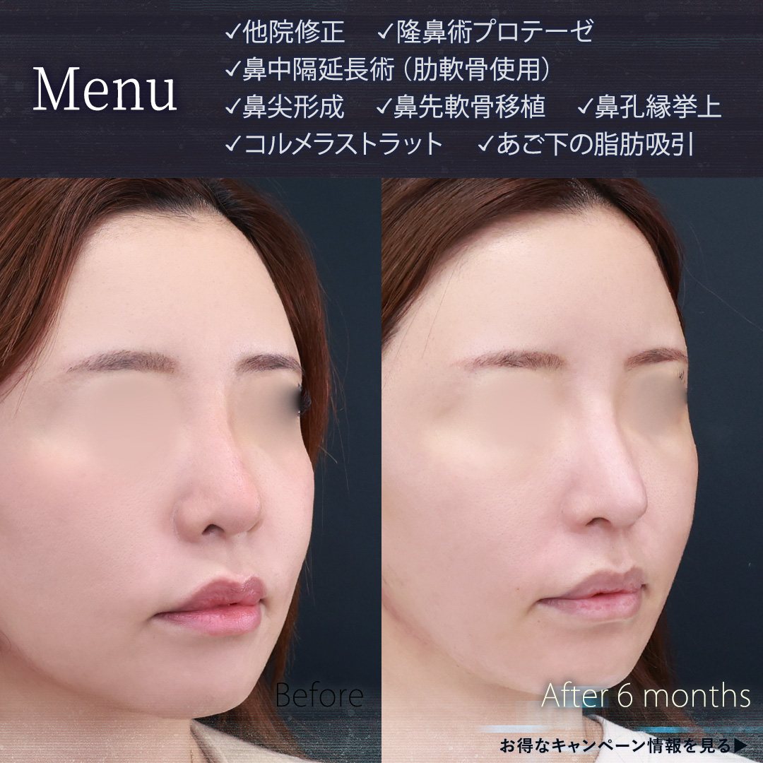 鼻中隔延長術/鼻先軟骨移植/鼻孔縁挙上術の症例写真 施術前後 