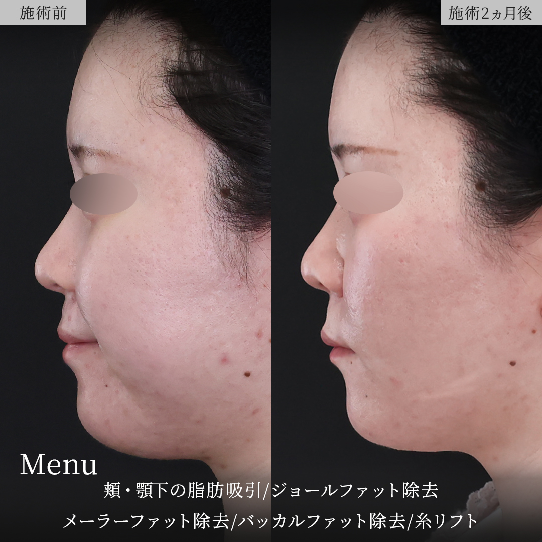TAC式 ツヤ肌コラーゲンリフト®/ジョールファット除去/バッカルファット除去の症例写真 施術前後