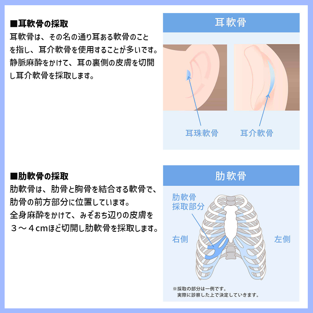 鼻中隔延長術/鼻先軟骨移植/鼻尖形成・鼻尖縮小の症例写真 施術前後 