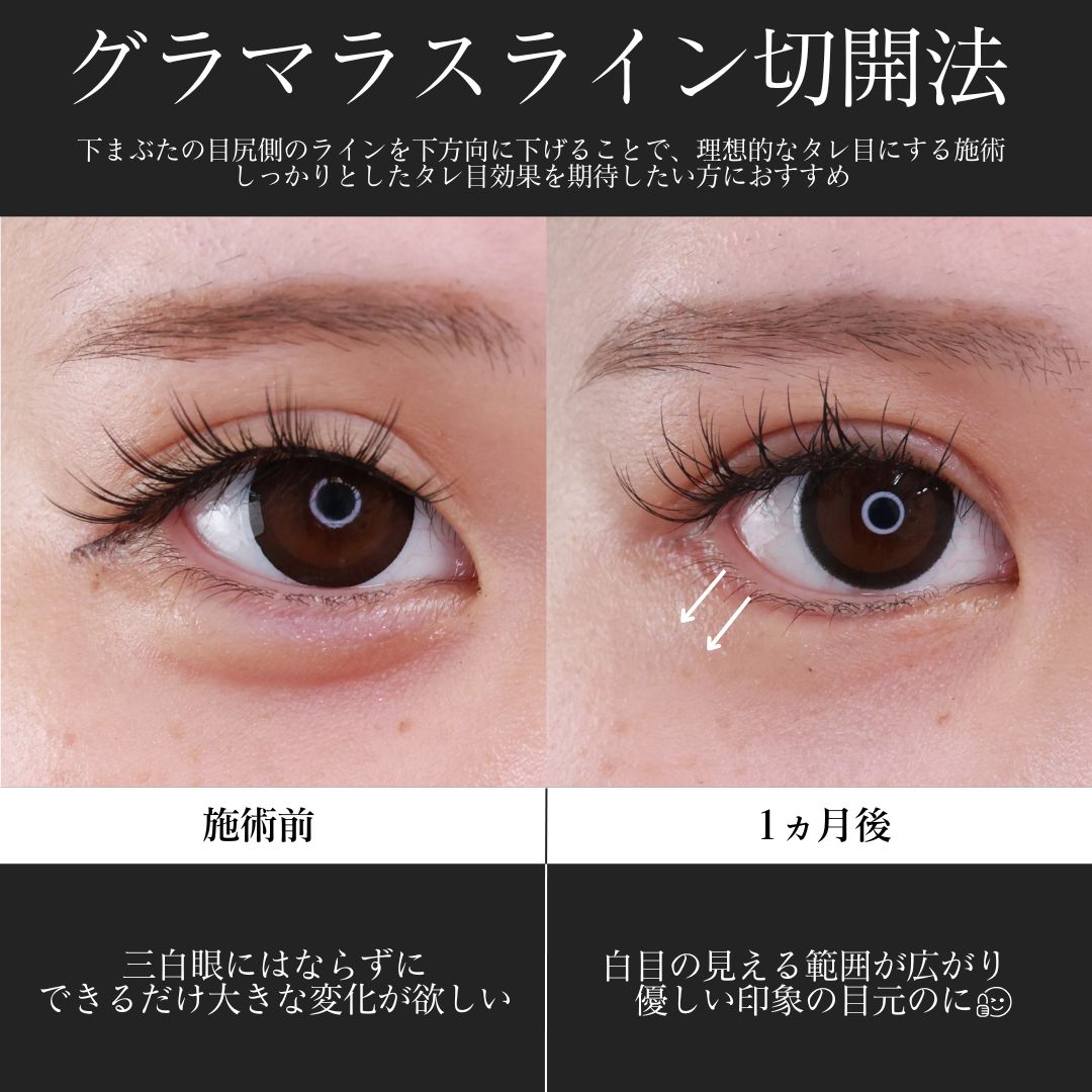 グラマラスライン（タレ目形成）/上眼瞼切開術/下眼瞼脱脂術（目の下のたるみ取り・目の下の脂肪ふくらみ取り）の症例写真 施術前後 