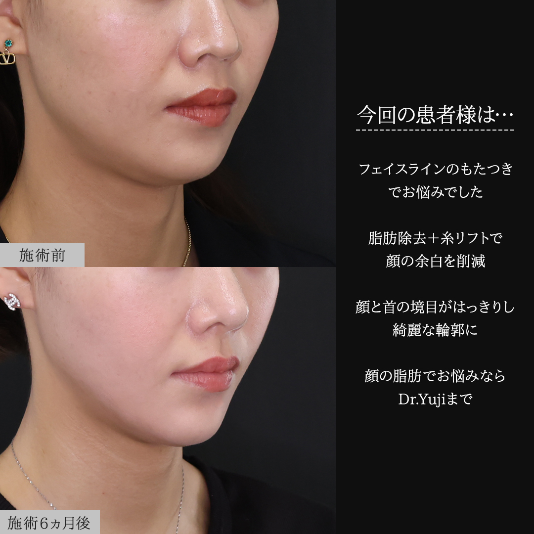 TAC式 ツヤ肌コラーゲンリフト®/メーラーファット除去/顔の脂肪吸引の症例写真 施術前後