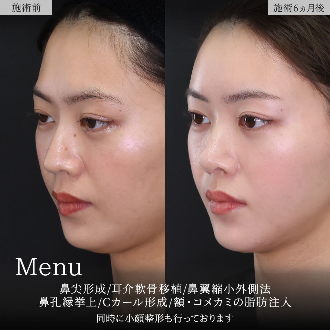 鼻尖形成・鼻尖縮小/鼻先軟骨移植/TAC式 鼻翼縮小術（小鼻縮小）の症例写真 施術前後 