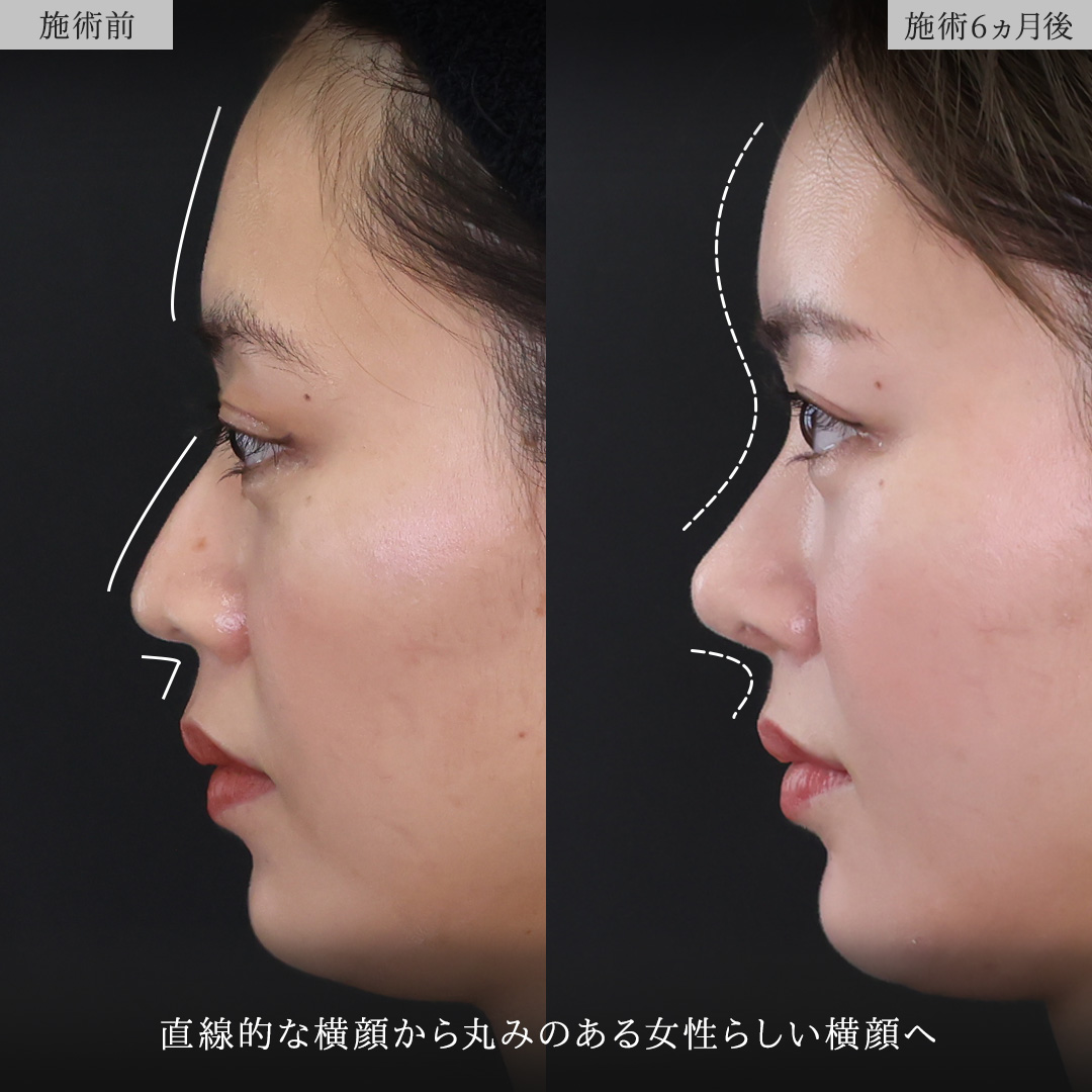 鼻尖形成・鼻尖縮小/鼻先軟骨移植/TAC式 鼻翼縮小術（小鼻縮小）の症例写真 施術前後 