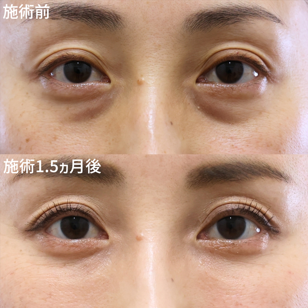 下眼瞼脱脂術（目の下のたるみ取り・目の下の脂肪ふくらみ取り）の症例写真 施術前後 