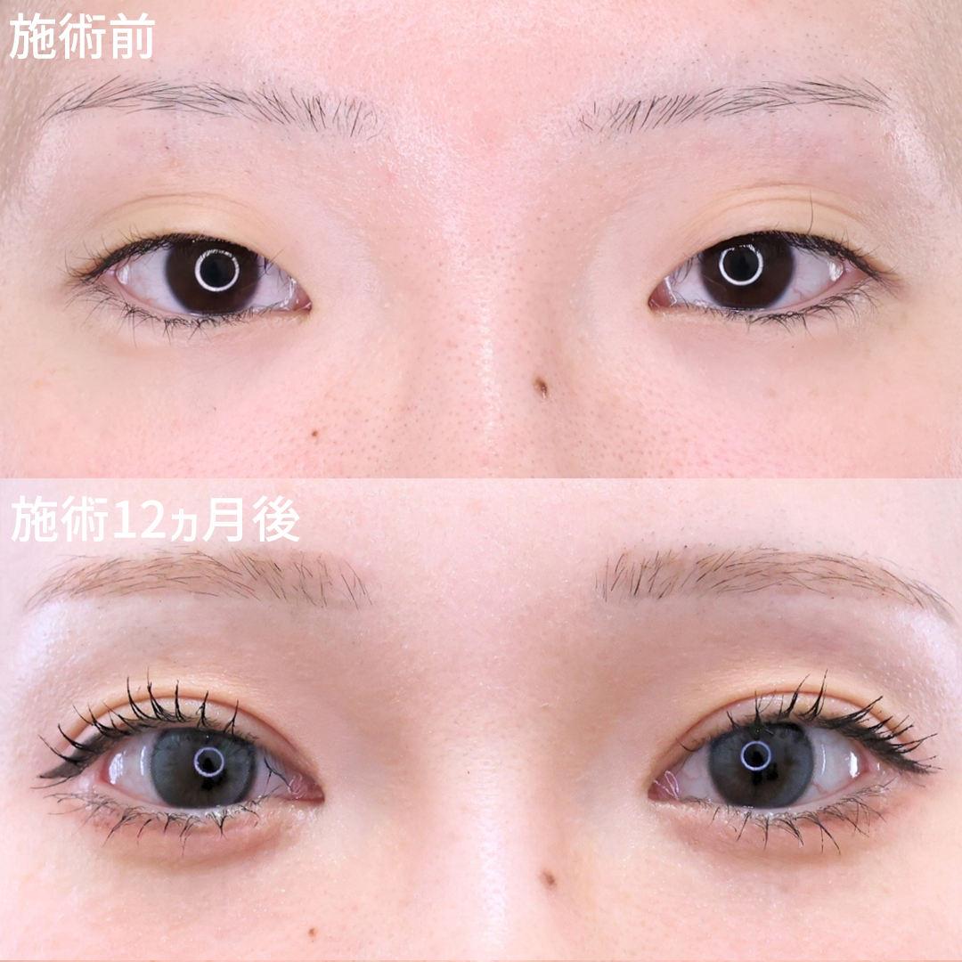 【埋没×目元切開】貴重な長期経過