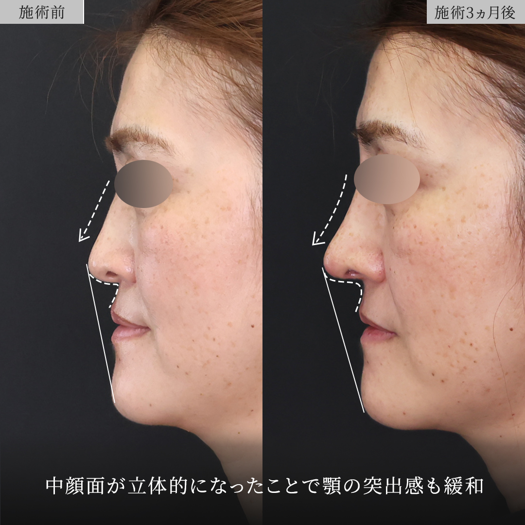 鼻中隔延長術/鼻尖形成・鼻尖縮小/鼻先軟骨移植の症例写真 施術前後 