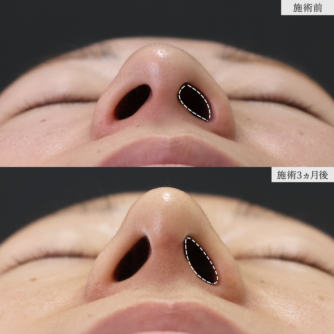 鼻尖形成・鼻尖縮小/鼻先軟骨移植の症例写真 施術前後 