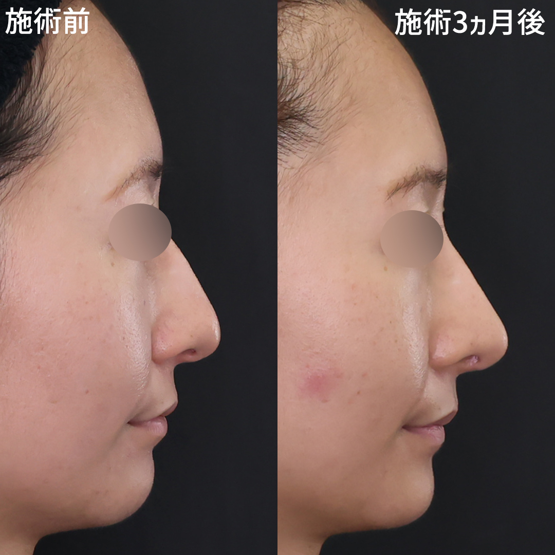 美人の鼻はここが違う　Dr.古川の鼻整形
