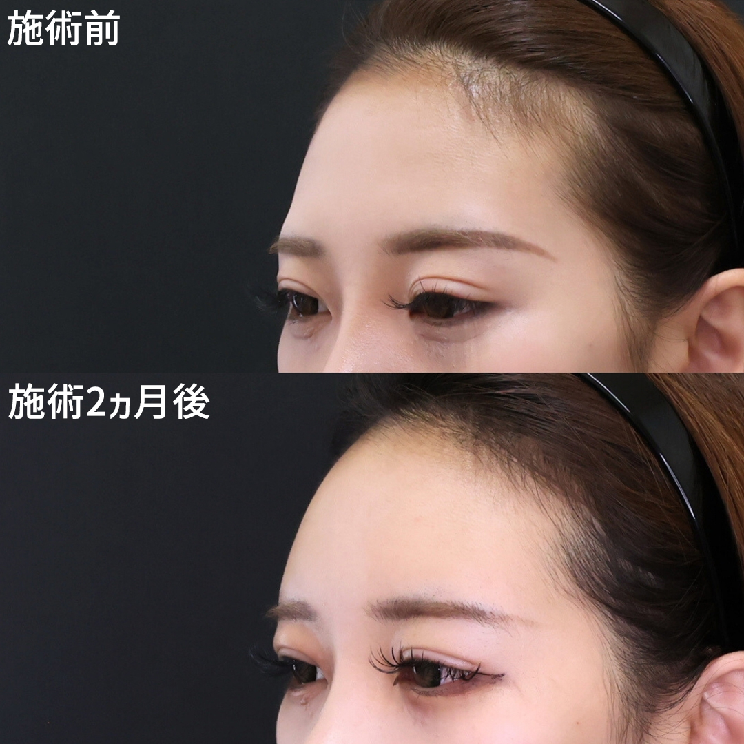 【額～コメカミの脂肪注入】痩せ型女性の脂肪注入　他院で断られた方も一度ご相談ください！