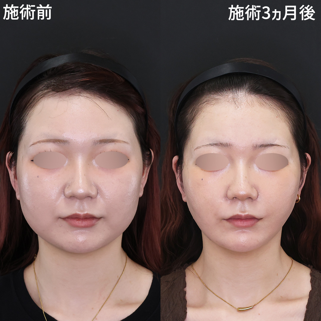 ホームベース型輪郭から卵型へ！　美人はこっそりやっている　Dr.古川の別人級小顔術