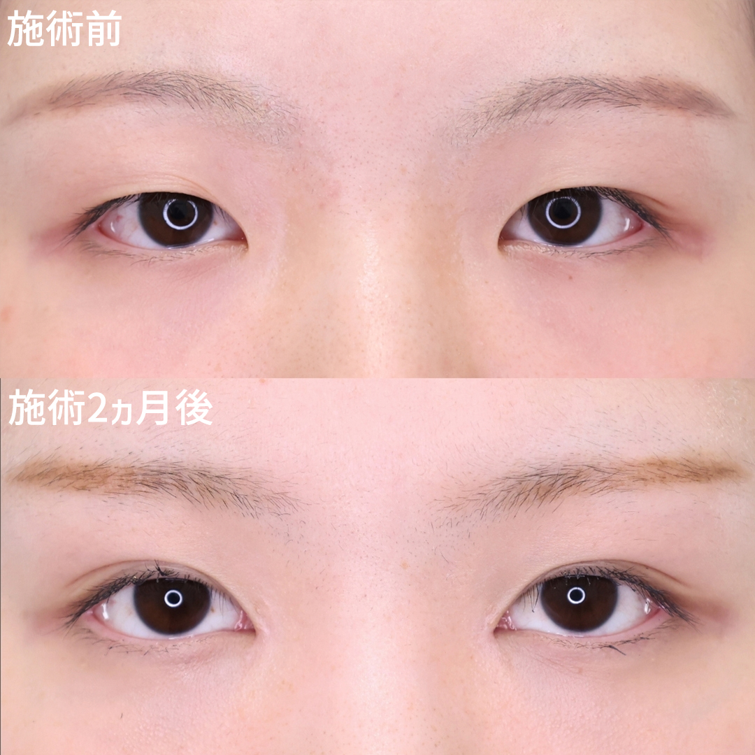離れ目・小粒目集合 埋没法+目頭切開で理想の目元へ