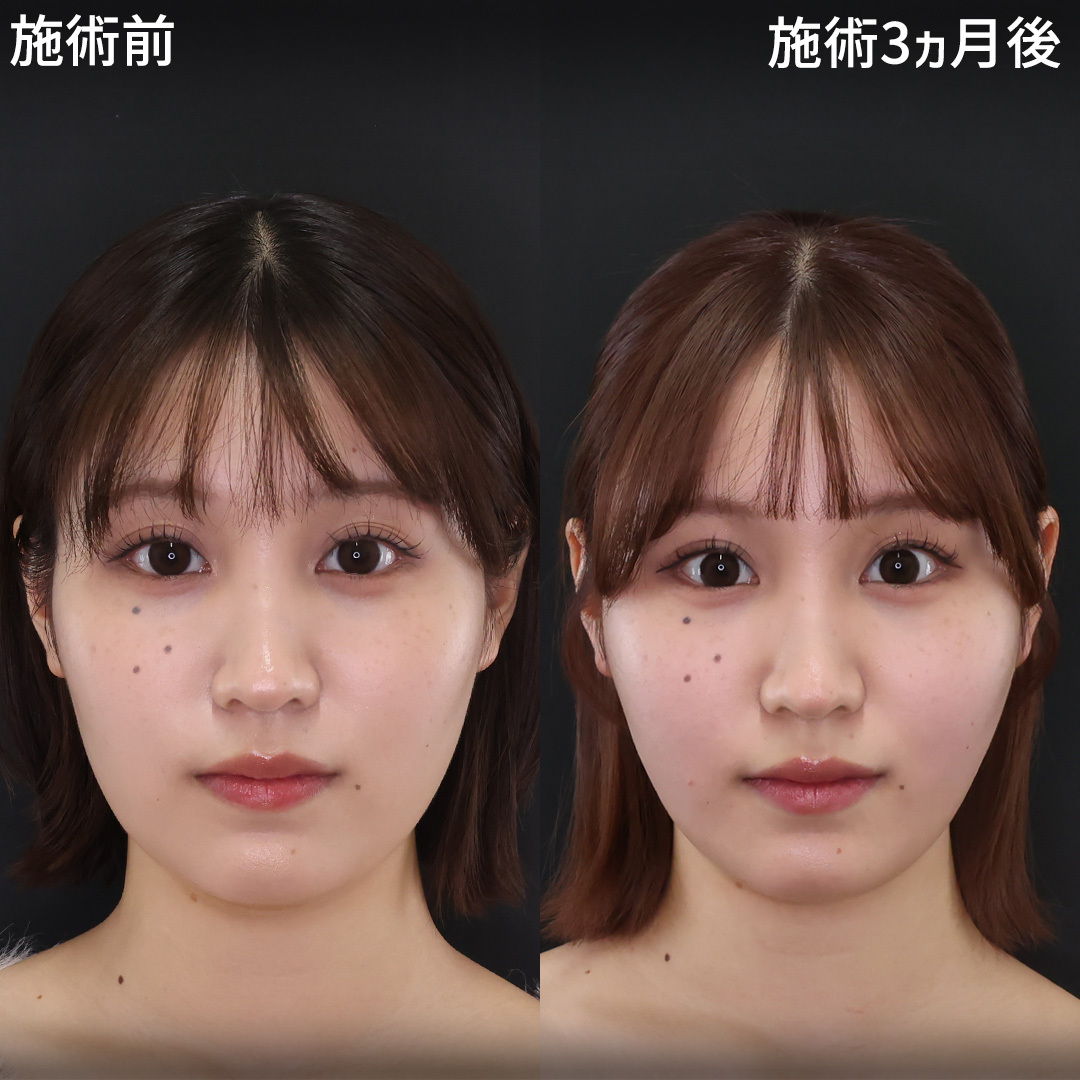 TAC式 ツヤ肌コラーゲンリフト®/顔の脂肪吸引/ジョールファット除去の症例写真 施術前後