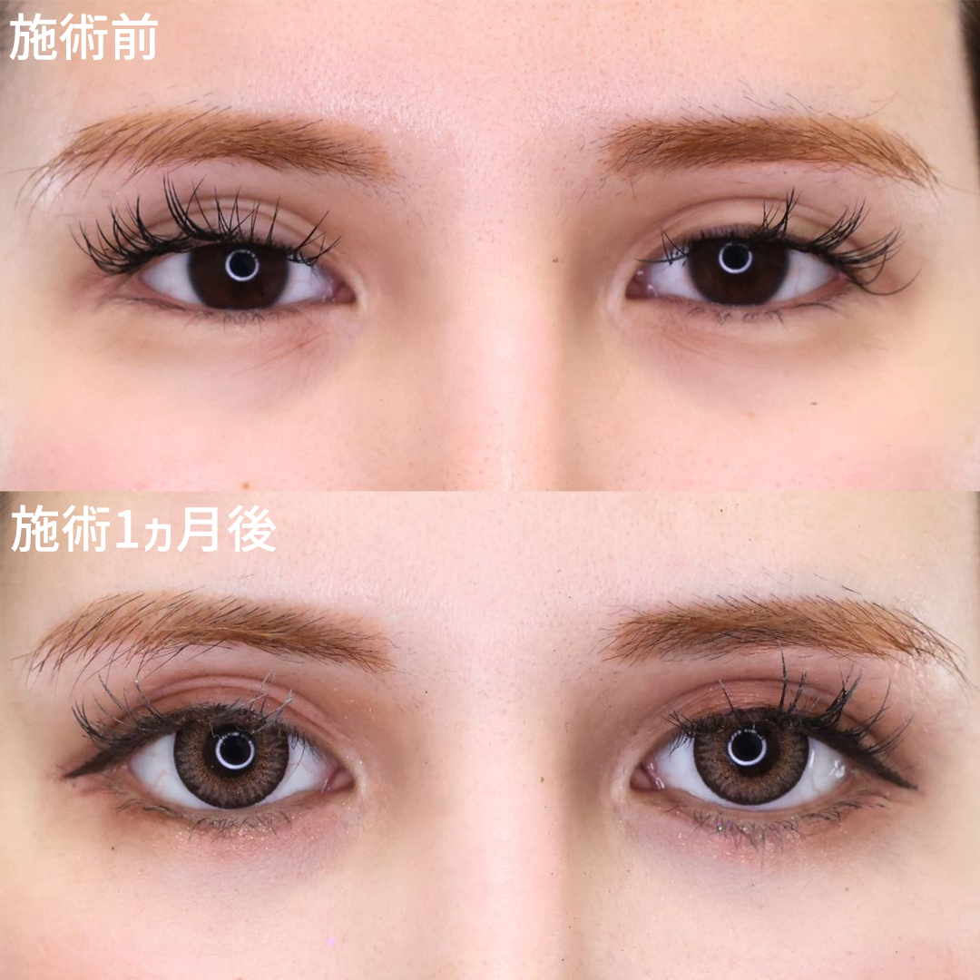 白目拡大でカラコンの映える目へ。グラマラスラインで限界まで目を大きく