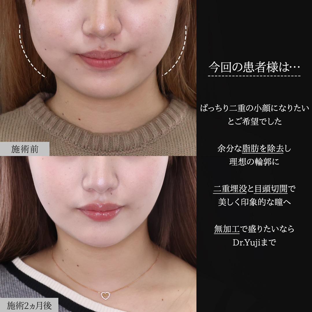 TAC式 ツヤ肌コラーゲンリフト®/顔の脂肪吸引/バッカルファット除去の症例写真 施術前後 