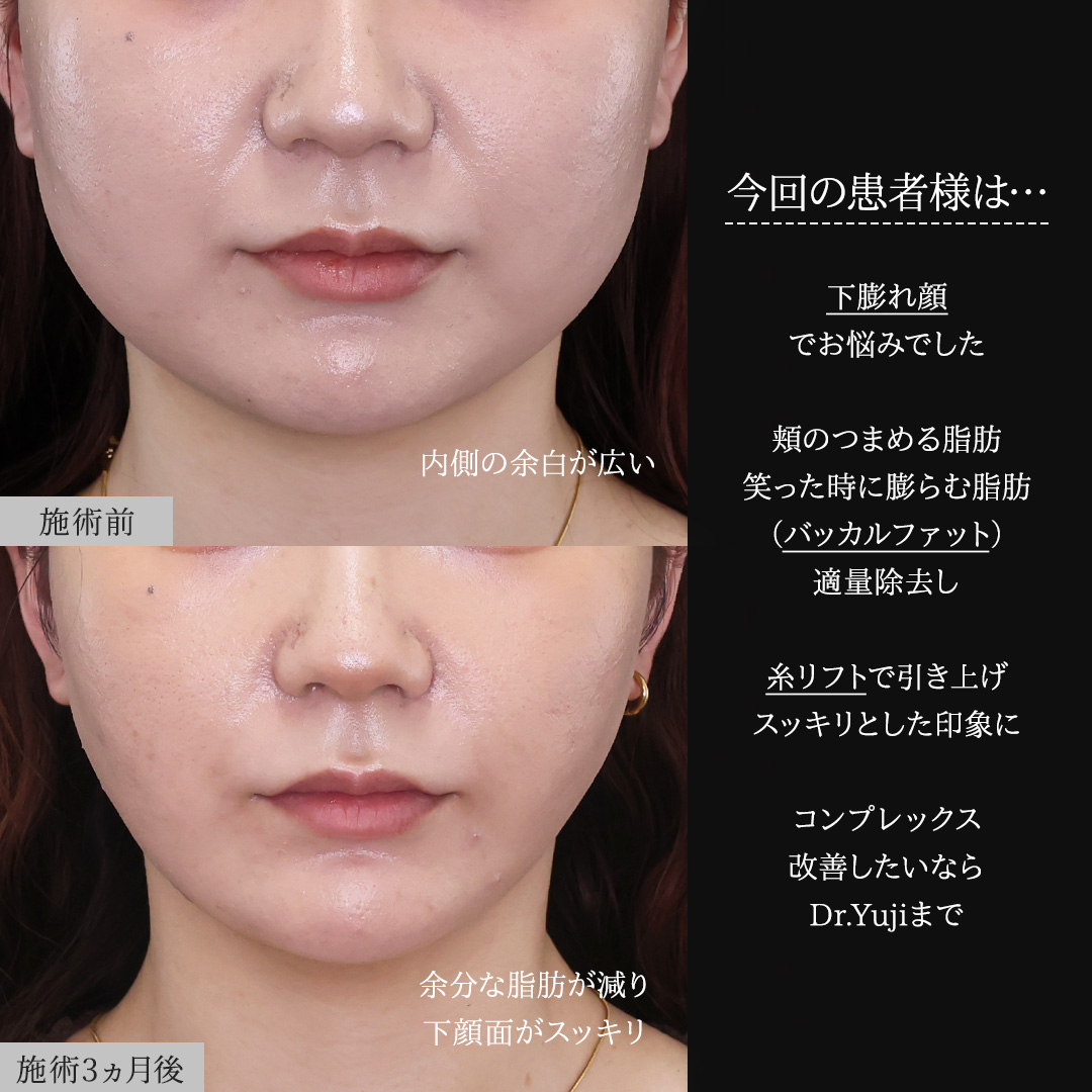 TAC式 ツヤ肌コラーゲンリフト®/顔の脂肪吸引/ジョールファット除去の症例写真 施術前後 