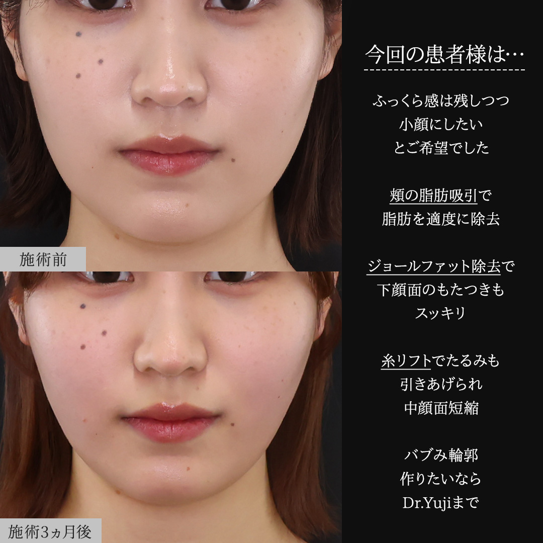 TAC式 ツヤ肌コラーゲンリフト®/顔の脂肪吸引/ジョールファット除去の症例写真 施術前後