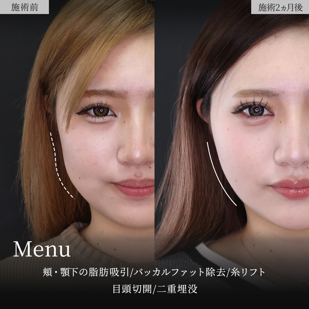 TAC式 ツヤ肌コラーゲンリフト®/顔の脂肪吸引/バッカルファット除去の症例写真 施術前後 