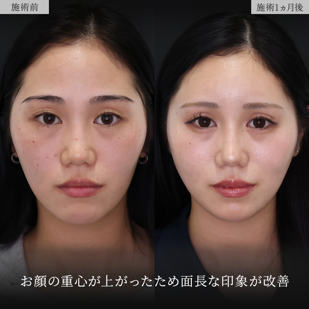 TAC式 ツヤ肌コラーゲンリフト®/おでこ・こめかみのヒアルロン酸注射/おでこボトックス注射の症例写真 施術前後