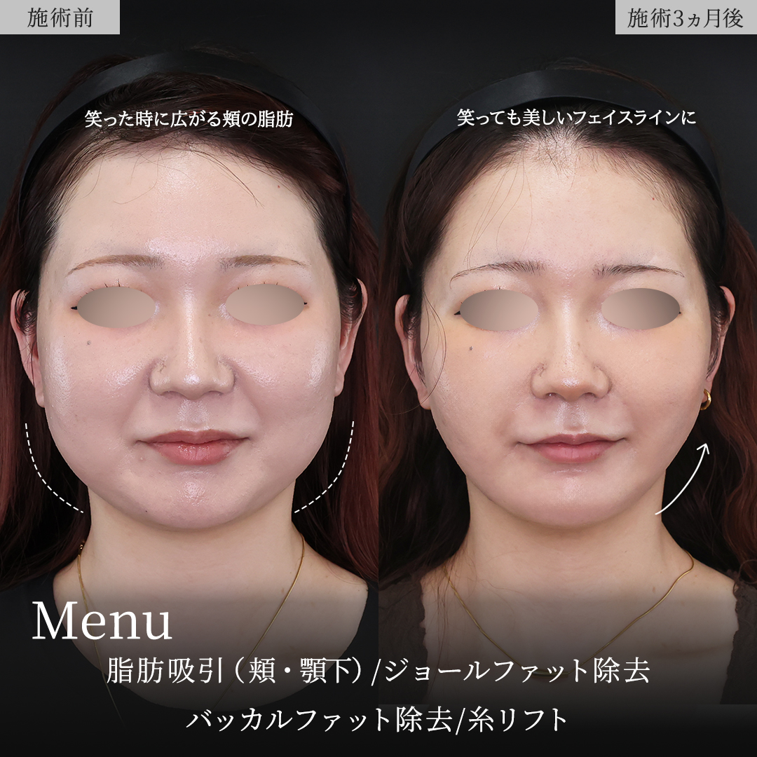 TAC式 ツヤ肌コラーゲンリフト®/顔の脂肪吸引/ジョールファット除去の症例写真 施術前後 