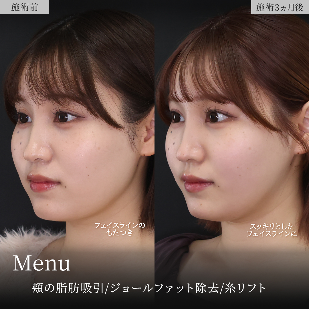 TAC式 ツヤ肌コラーゲンリフト®/顔の脂肪吸引/ジョールファット除去の症例写真 施術前後