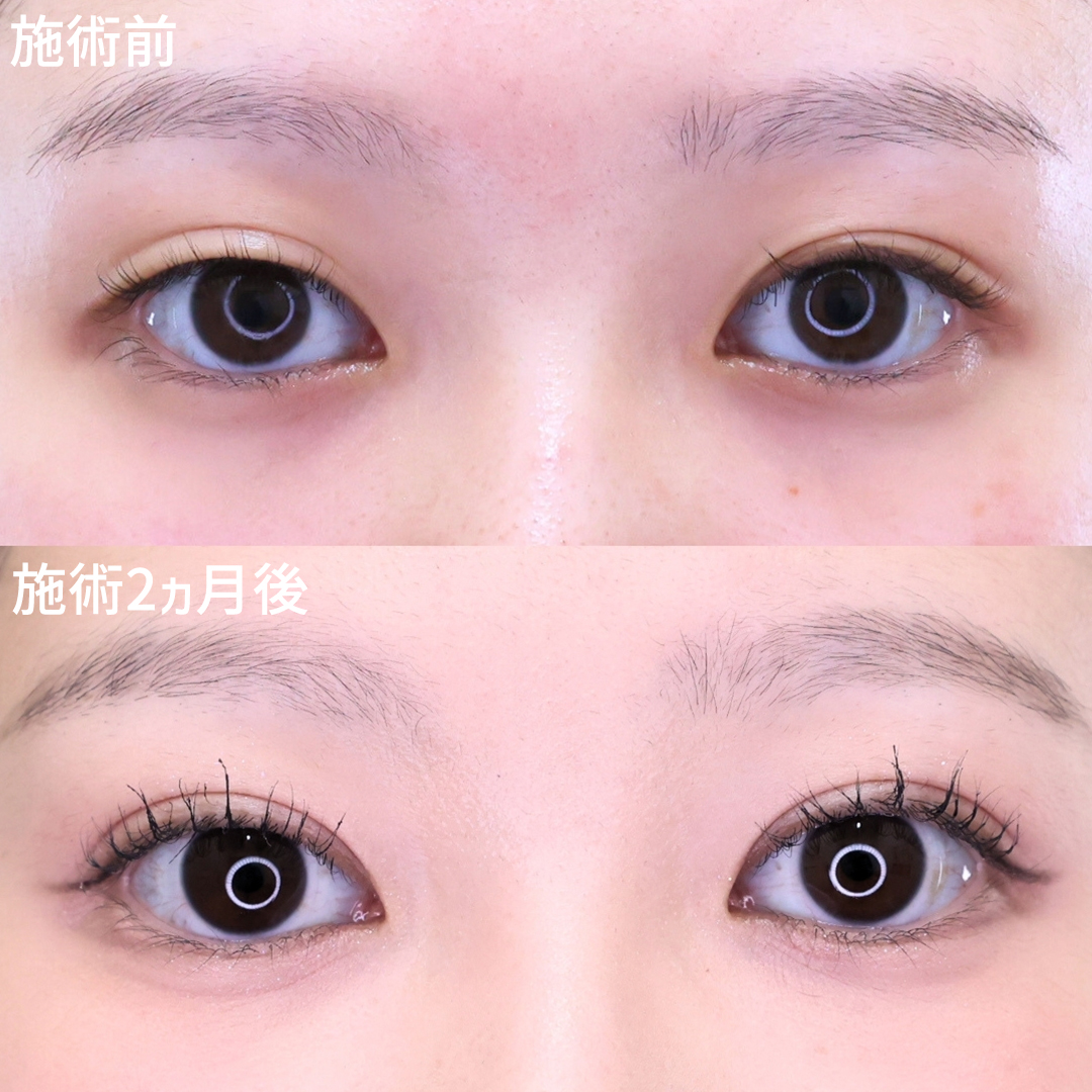 薄っすら二重と左右差は埋没法で改善！小動物の様なくりくりまん丸eye