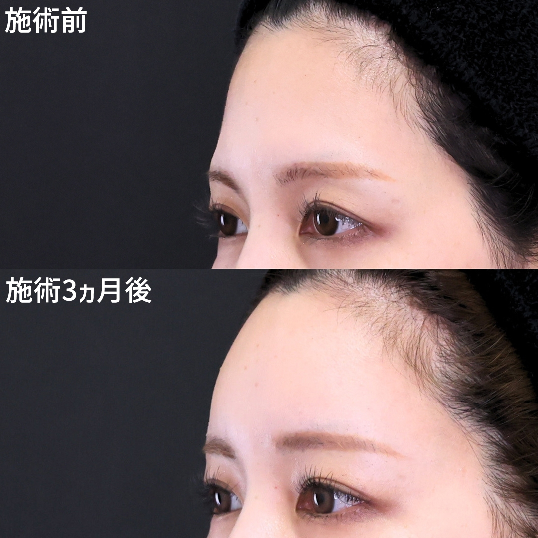 【額～コメカミの脂肪注入】ゴツゴツおでこは卒業！　丸いおでこで女性らしい印象に