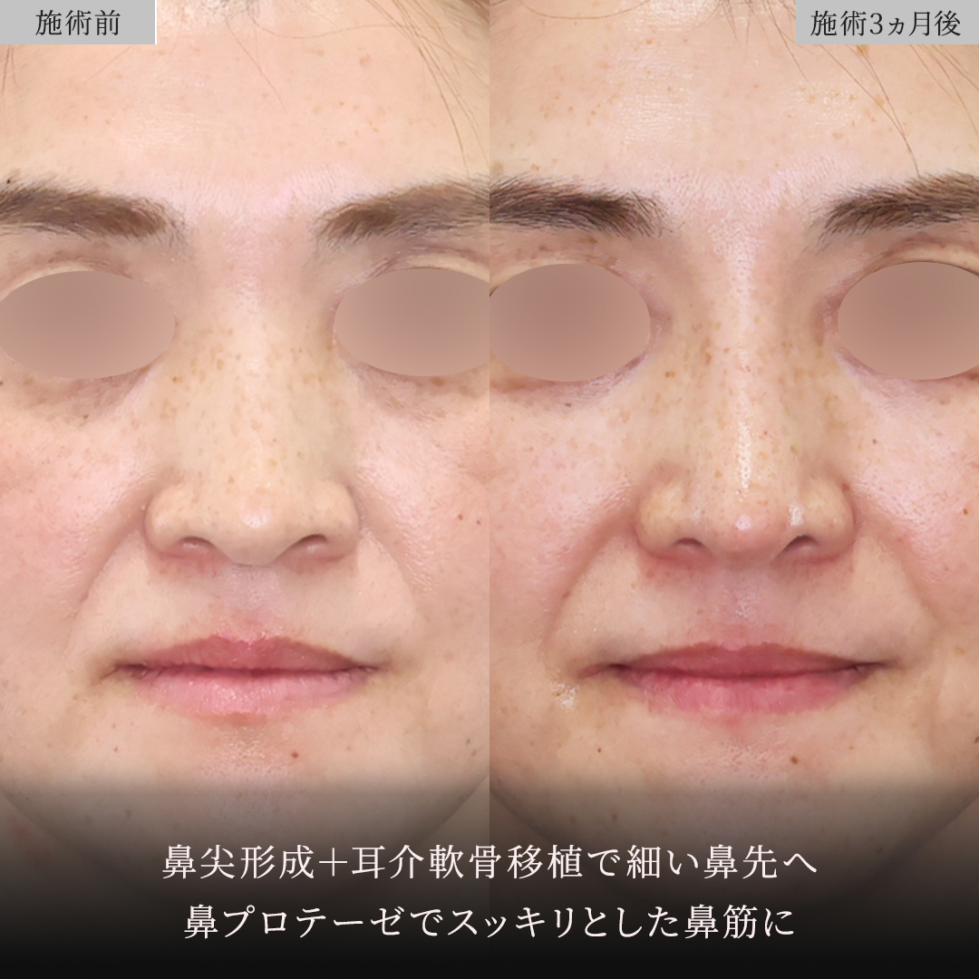 鼻中隔延長術/鼻尖形成・鼻尖縮小/鼻先軟骨移植の症例写真 施術前後 