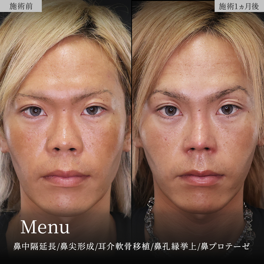 鼻中隔延長術/鼻尖形成・鼻尖縮小/隆鼻術（プロテーゼ・自家組織）の症例写真 施術前後 