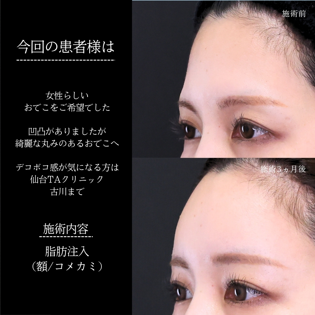 おでこの脂肪注入（オルチャンデコ形成）の症例写真 施術前後 