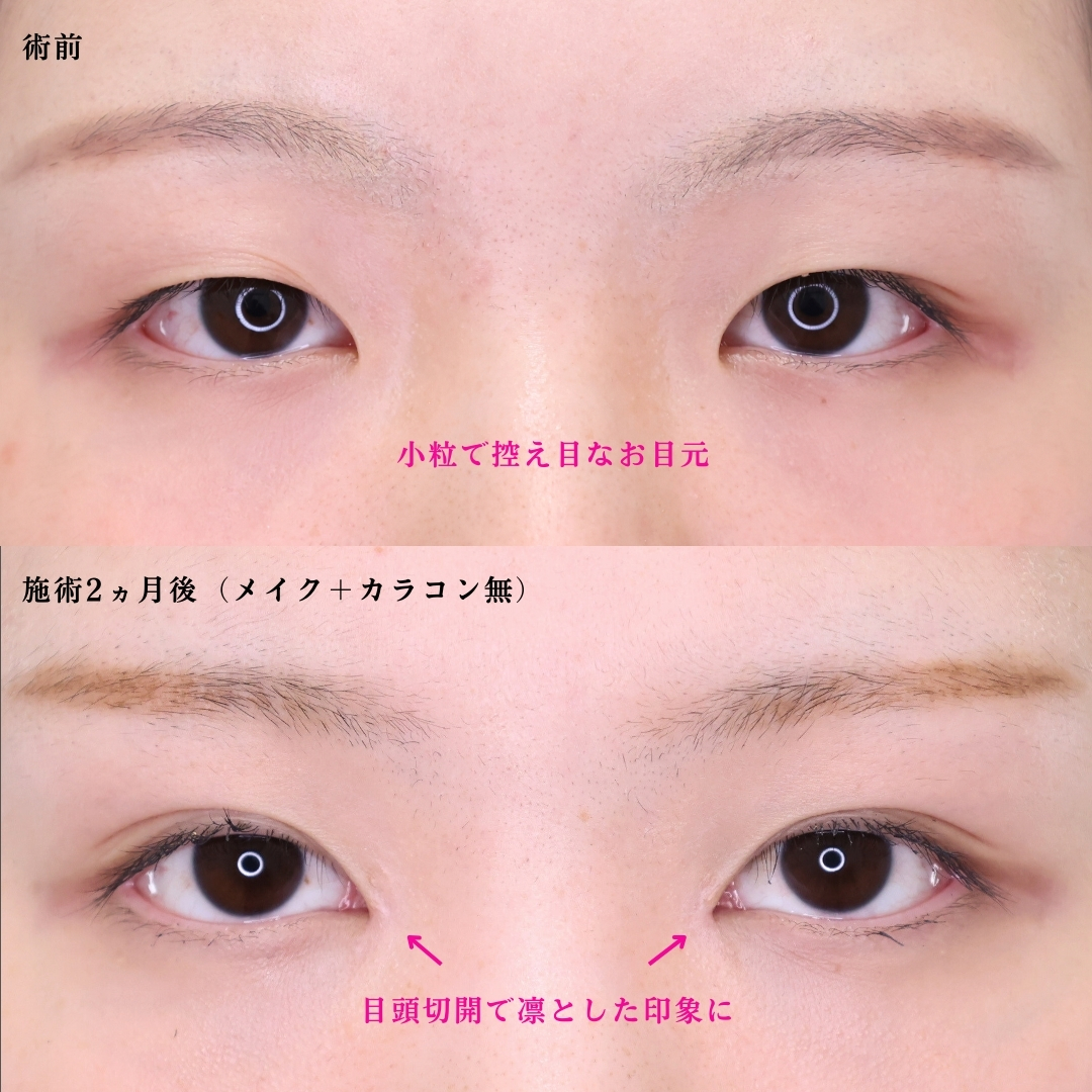 二重埋没法/目頭切開術の症例写真 施術前後 