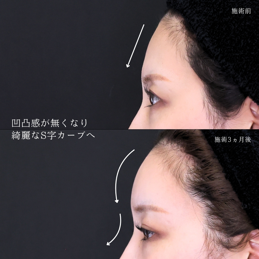 おでこの脂肪注入（オルチャンデコ形成）の症例写真 施術前後 