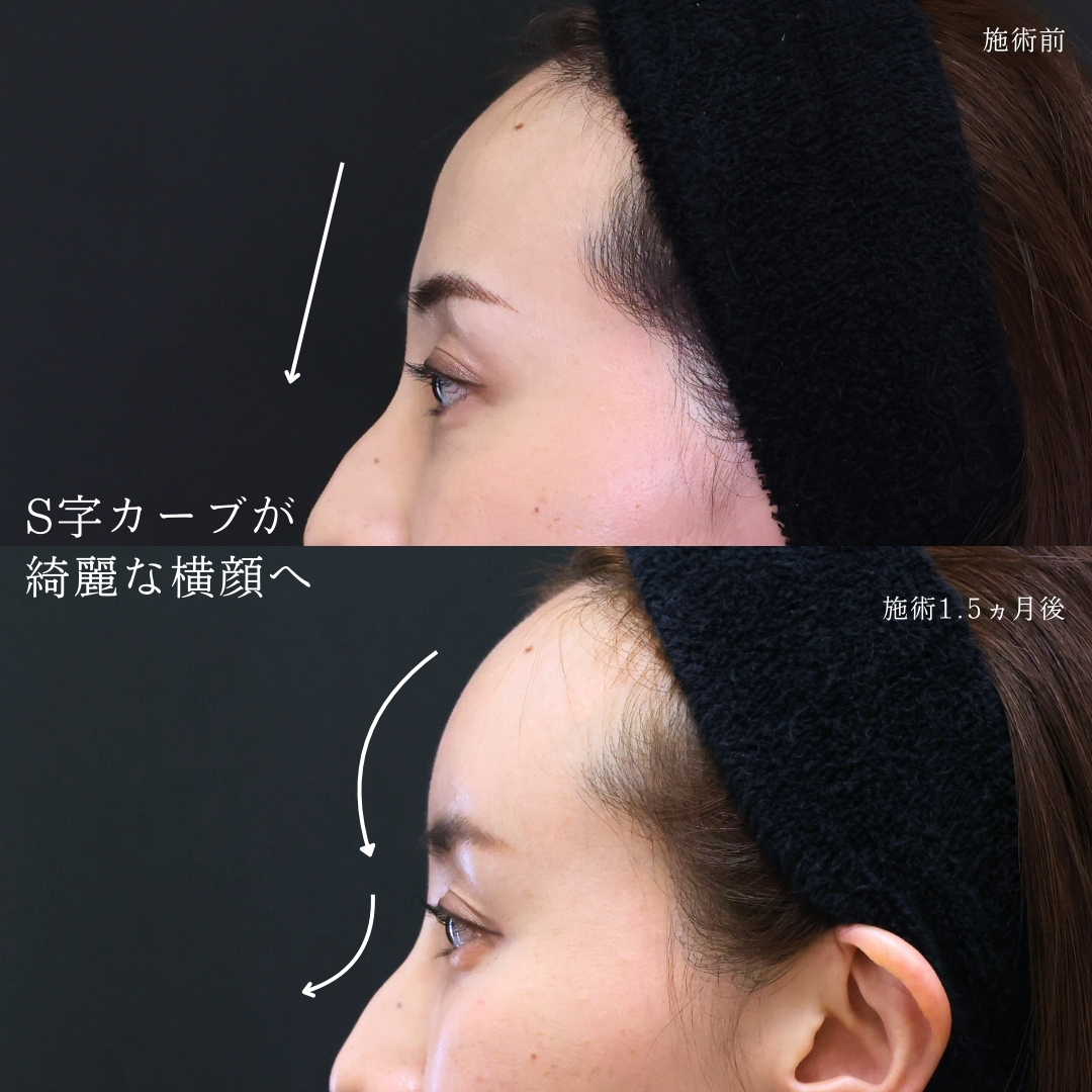 おでこの脂肪注入（オルチャンデコ形成）の症例写真 施術前後 