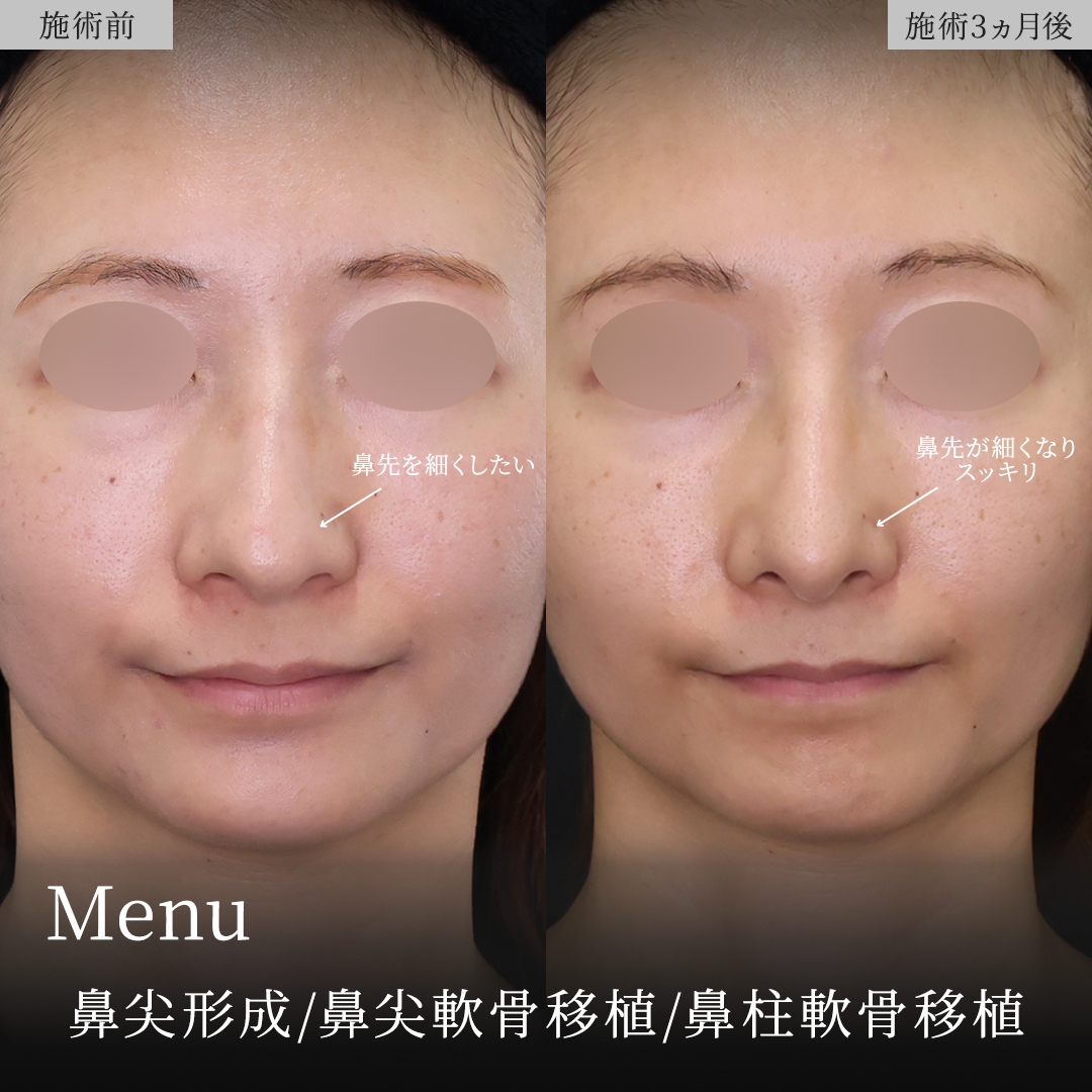 鼻尖形成・鼻尖縮小/鼻先軟骨移植の症例写真 施術前後 