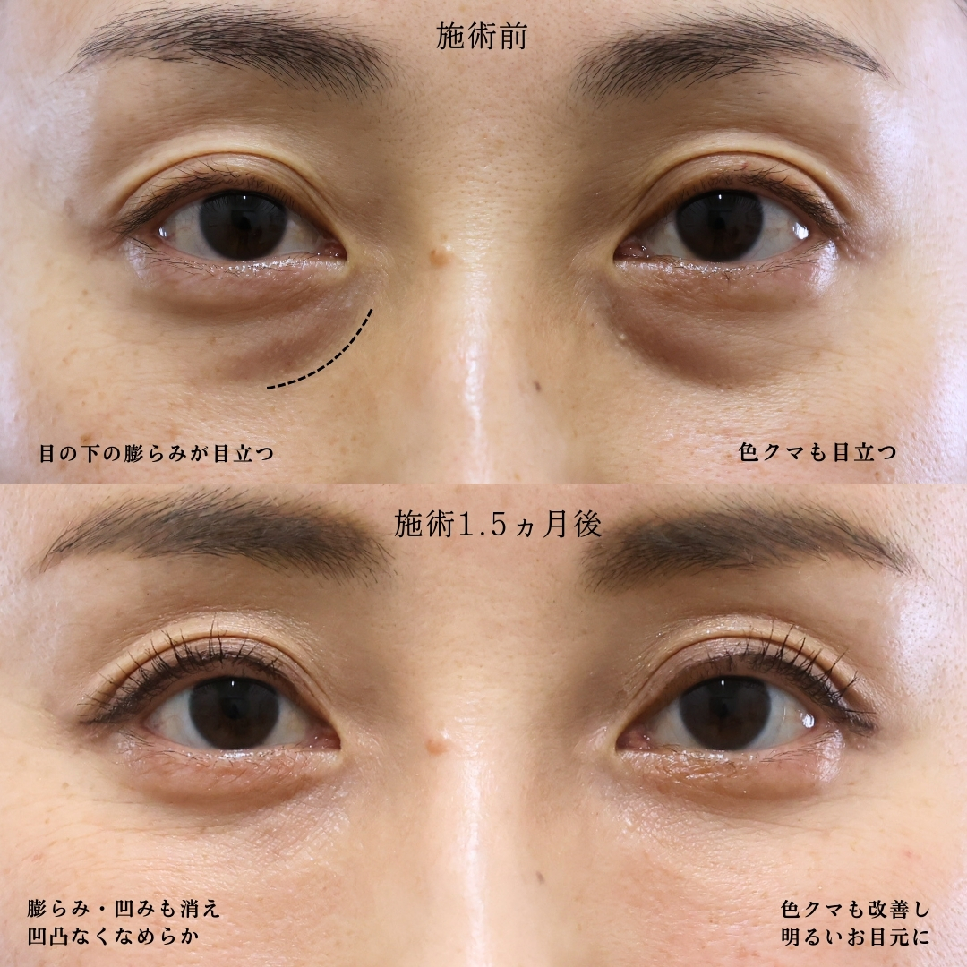 下眼瞼脱脂術（目の下のたるみ取り・目の下の脂肪ふくらみ取り）の症例写真 施術前後 