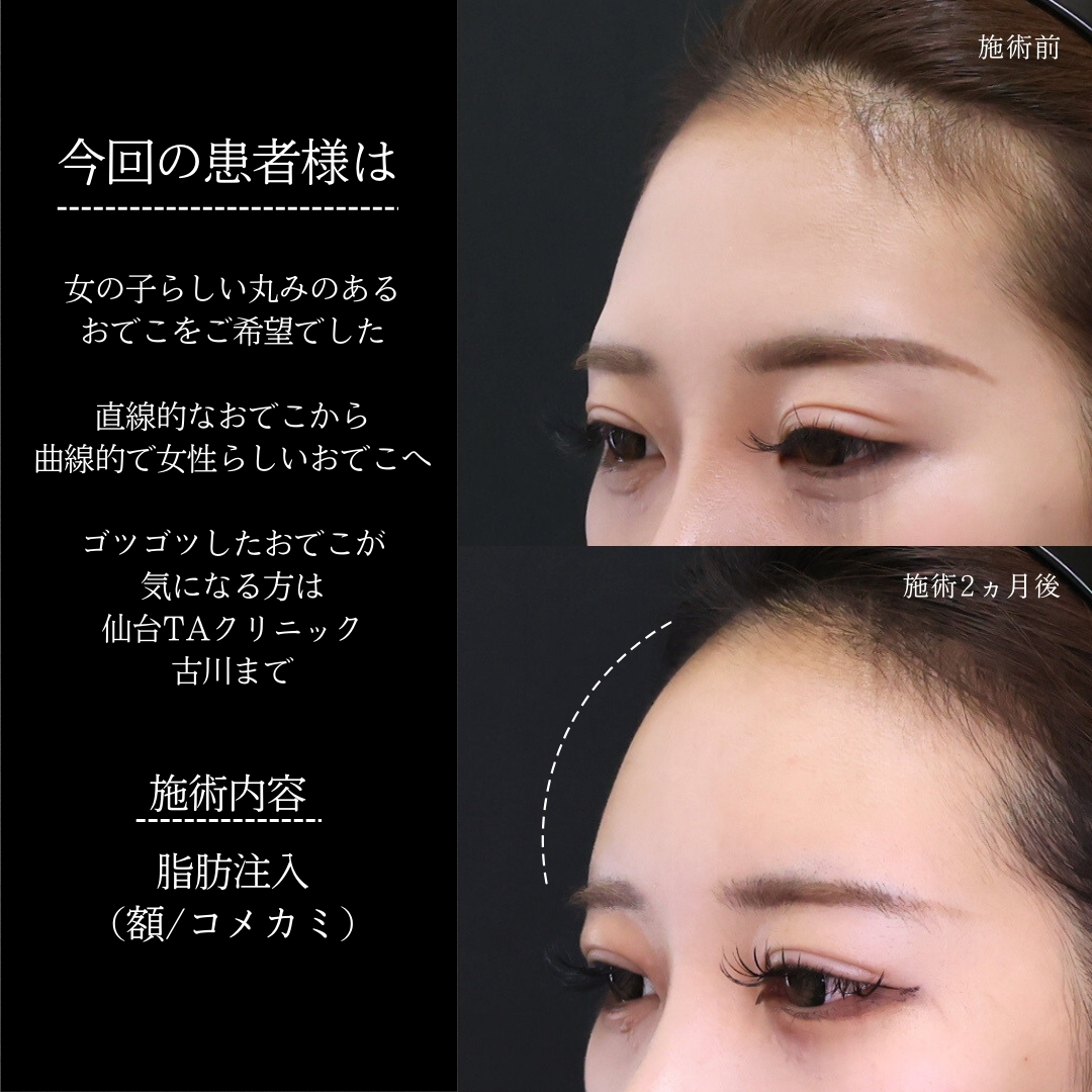 おでこ・こめかみのヒアルロン酸注射の症例写真 施術前後 