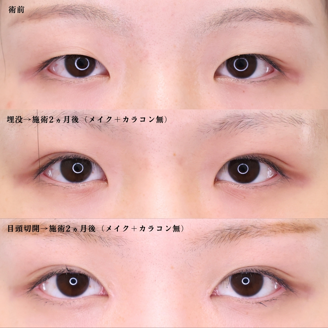 二重埋没法/目頭切開術の症例写真 施術前後 