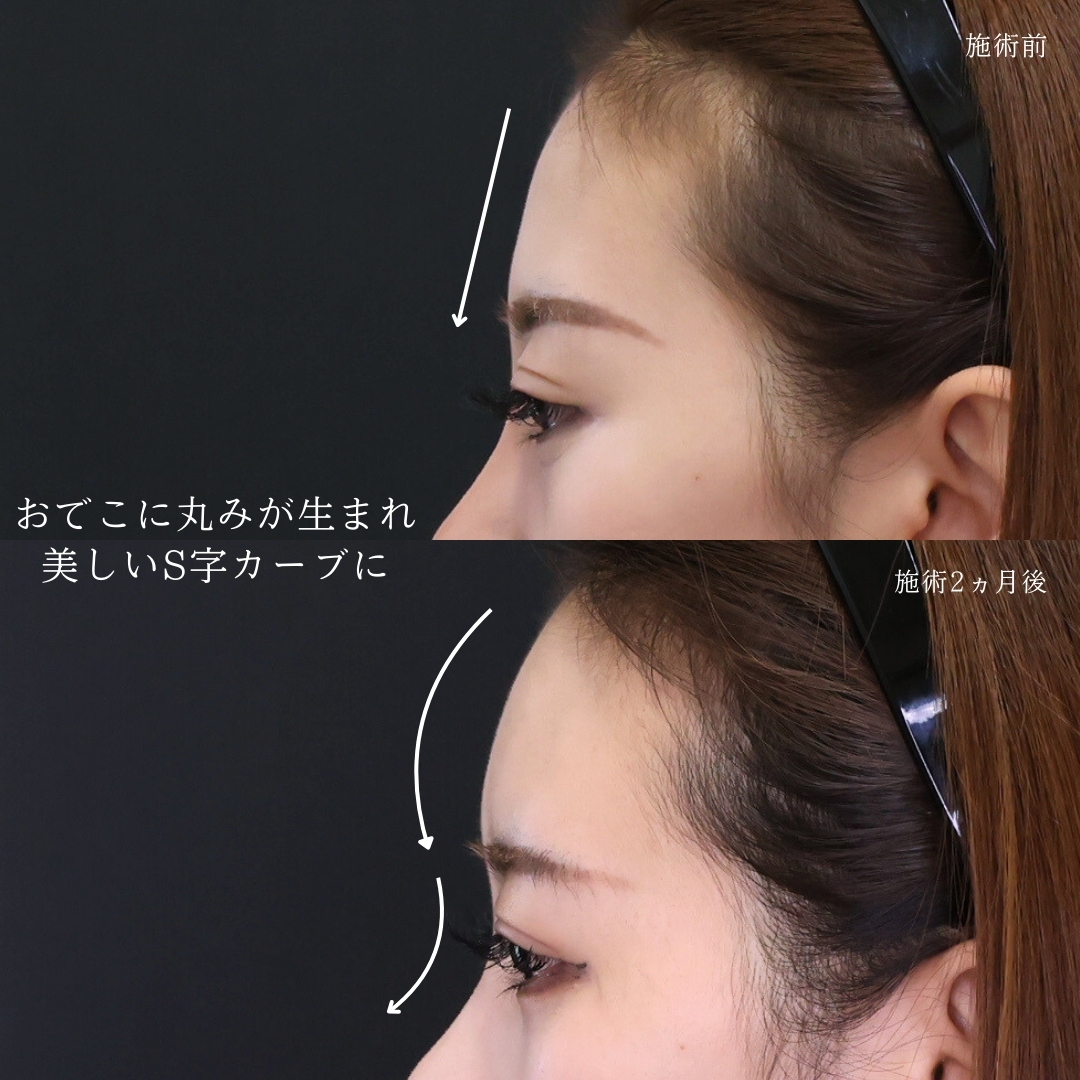 おでこ・こめかみのヒアルロン酸注射の症例写真 施術前後 