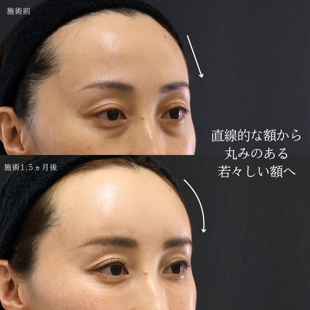 おでこの脂肪注入（オルチャンデコ形成）の症例写真 施術前後 